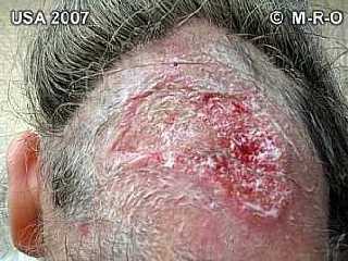 Haarausfall, Alopezie durch Morgellons, Bildquelle: http://www.morgellons-research.org/morgellons2/